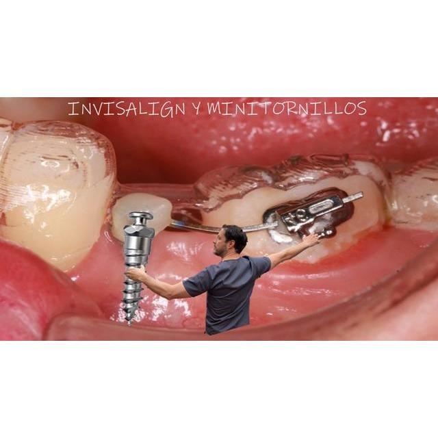 Formación: Curso Invisalign y minitornillos 13-14 MAYO 2022