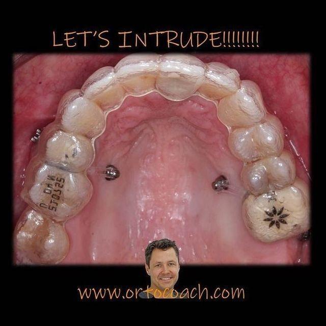 Formación: Curso minitornillos & Invisalign 19 y 20 de febrero de 2021