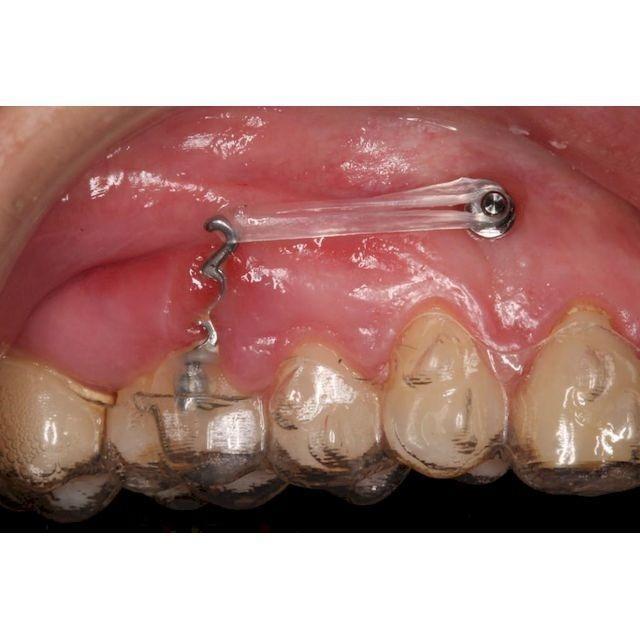 Formación: Curso minitornillos & Invisalign 19 y 20 de febrero de 2021
