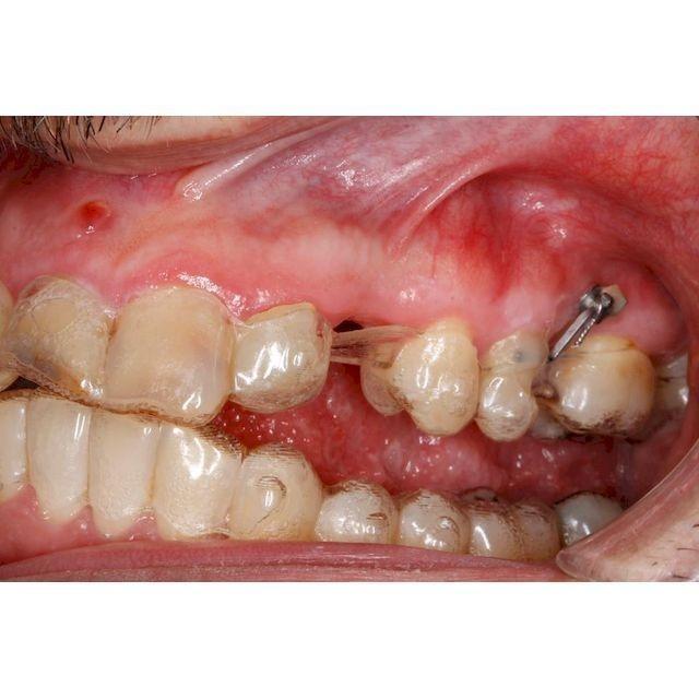 Formación: Curso minitornillos & Invisalign 19 y 20 de febrero de 2021