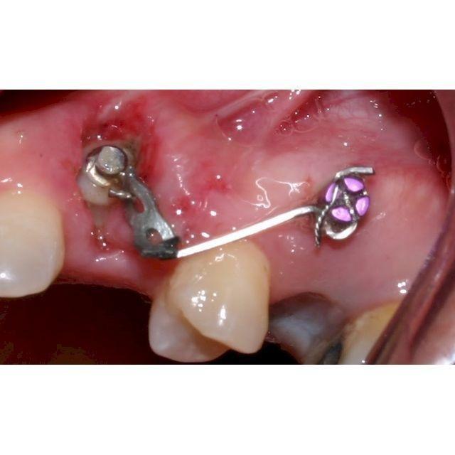 Formación: Curso minitornillos & Invisalign 19 y 20 de febrero de 2021