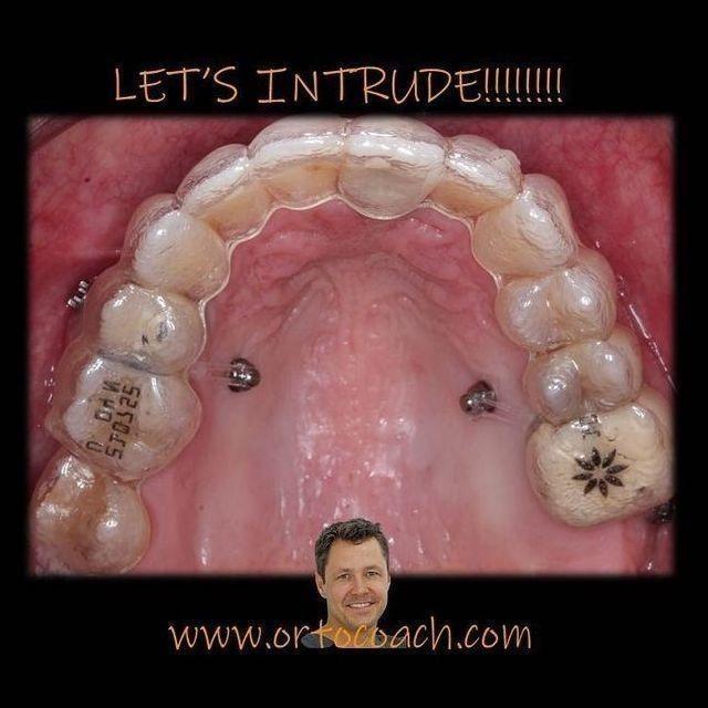 Formación: Curso minitornillos & Invisalign (III edición).  28 y 29 de mayo de 2021
