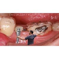 Formación: Curso Invisalign y minitornillos 13-14 MAYO 2022