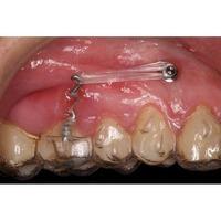 Formación: Curso minitornillos & Invisalign 19 y 20 de febrero de 2021