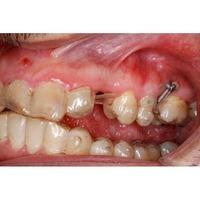 Formación: Curso minitornillos & Invisalign 19 y 20 de febrero de 2021
