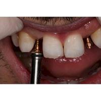 Formación: Curso minitornillos & Invisalign 19 y 20 de febrero de 2021