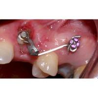 Formación: Curso minitornillos & Invisalign 19 y 20 de febrero de 2021