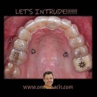 Formación: Curso minitornillos & Invisalign (II edición). 16 y 17 de abril de 2021