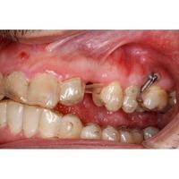 Formación: Curso minitornillos & Invisalign (II edición). 16 y 17 de abril de 2021